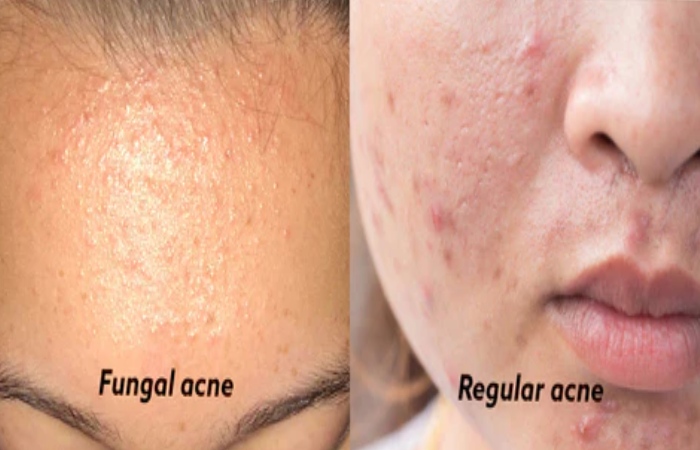 What are the Causes of Fungal Acne?