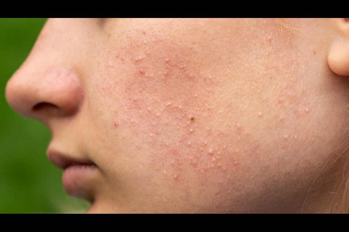 Fungal Acne Write for Us